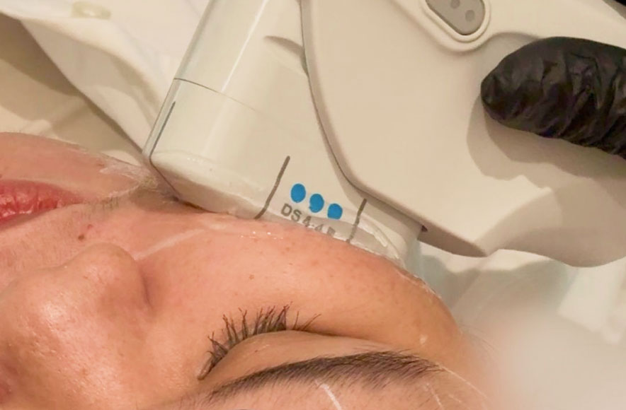Ultherapy