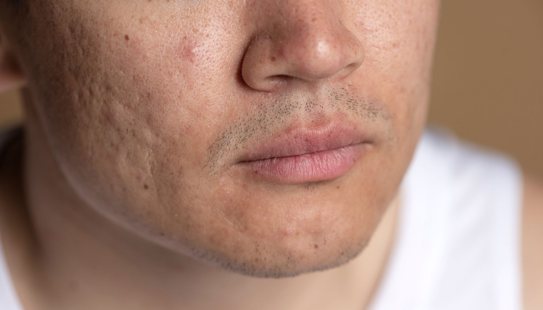 Acne Scars