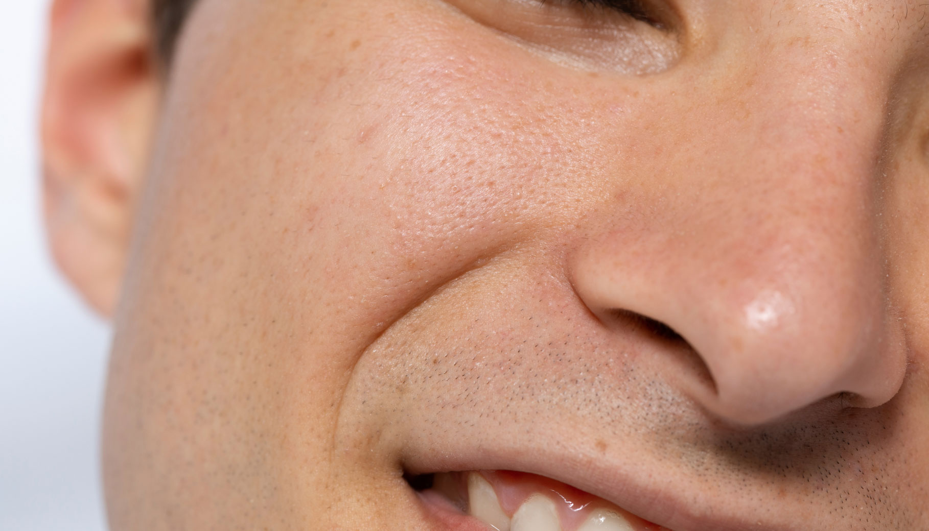 Enlarged Pores
