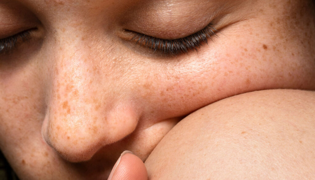 Pigmentation & Melasma